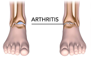 Use of Tramadol for Arthritis